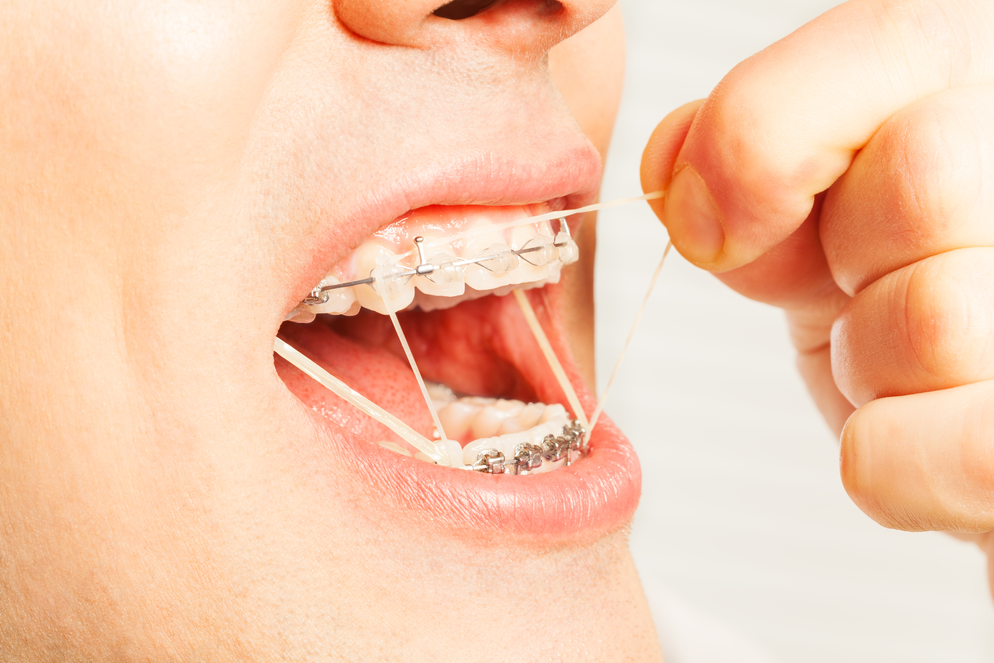 Ortodont vam lahko pomaga izbrati najustreznejši zobni aparat